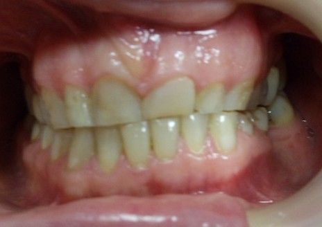 Close-up of a mouth showing teeth and gums with visible dental crowding and misalignment