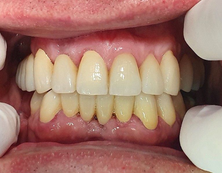 Close-up of teeth and gums with cheek retractors, showing mild yellowing and slight crowding