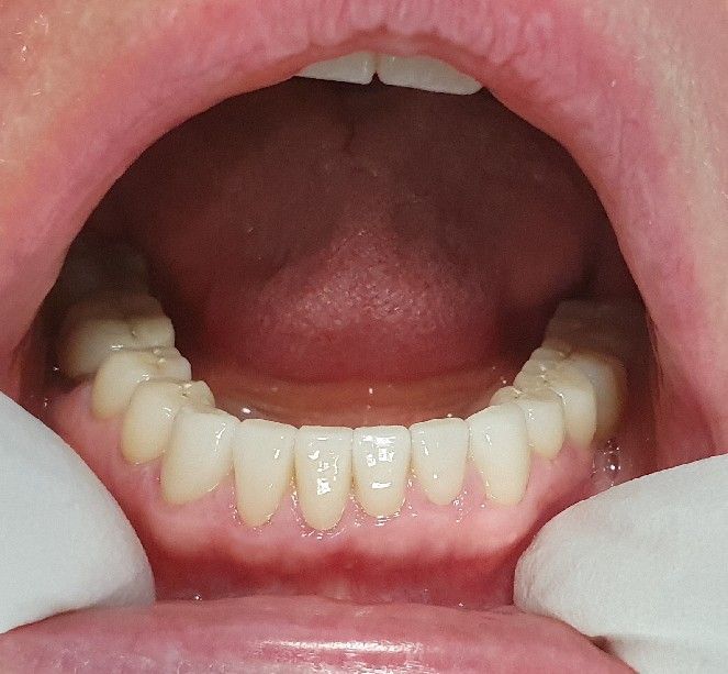 Open mouth showing lower front teeth and gums, with fingers gently pulling the lips apart