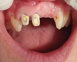 broken-teeth-before-dental-implant