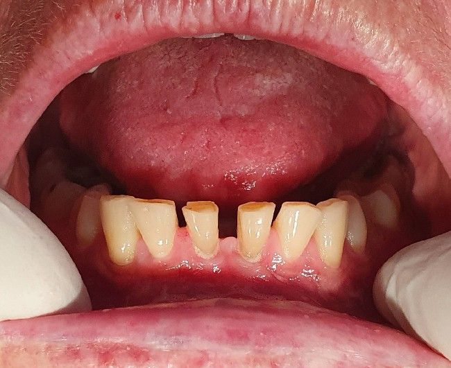 Open mouth showing lower front teeth with yellow staining and gaps, held by gloved hands
