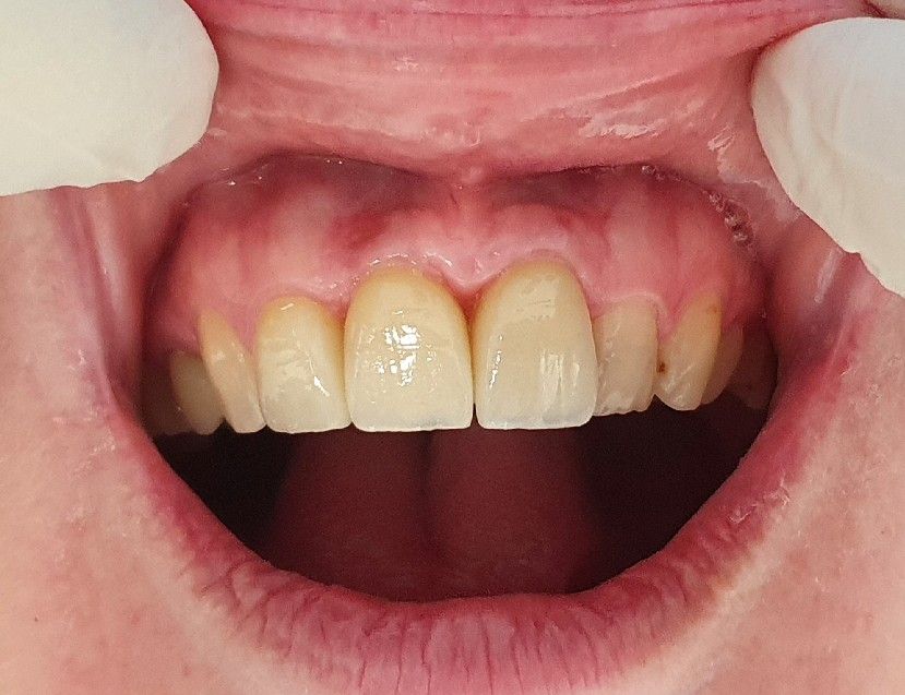 Close-up of open mouth showing upper front teeth with yellowing and gum redness