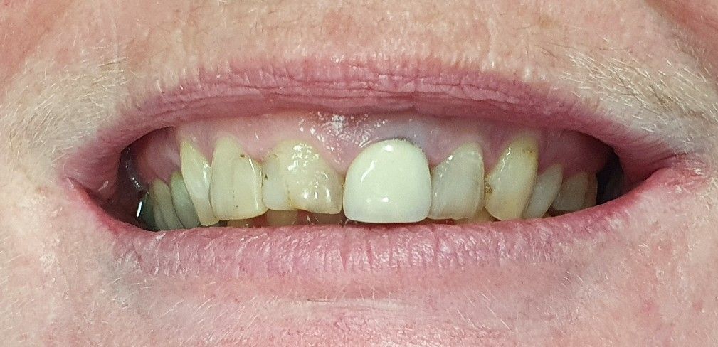 Close-up of teeth with a single white front tooth or dental implant centered in a smile