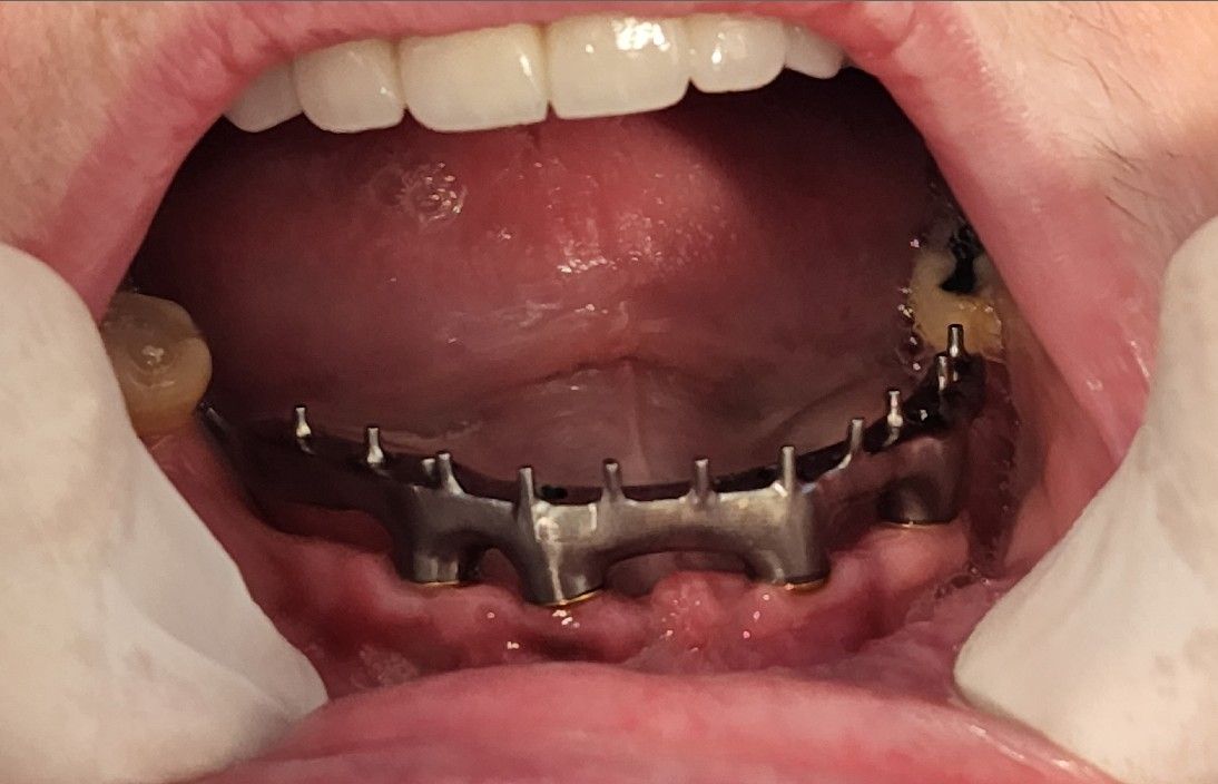 Close-up of an open mouth with a lower dental retainer or braces visible
