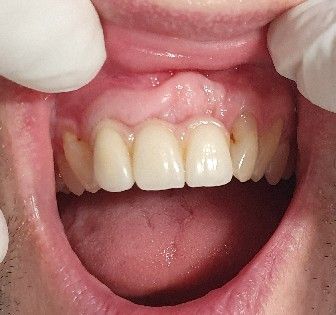 after-dental-implant