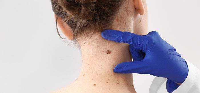 visita dermatologo al Laboratorio Analisi Cliniche BIOCAVA Cava de' Tirreni (SA)