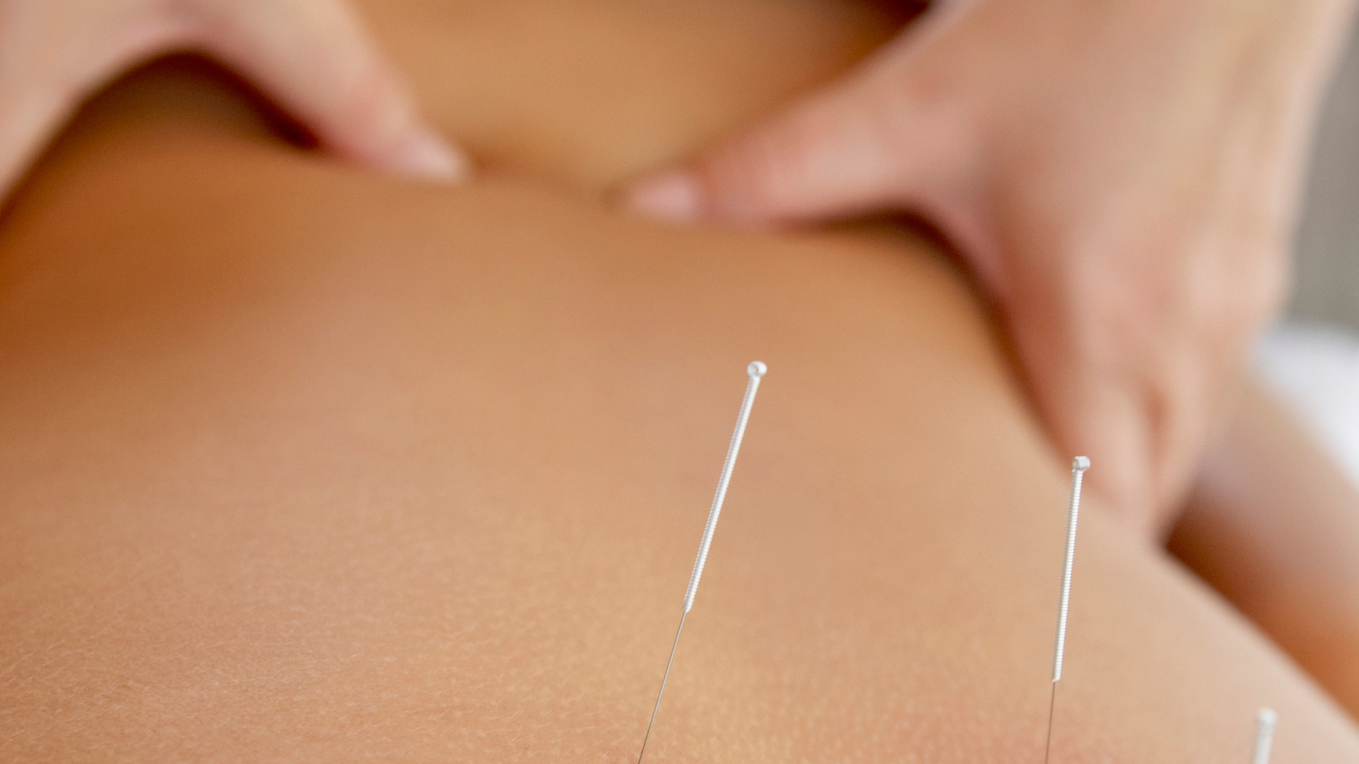 Needles inserted in a person's back during an acupuncture session. A person's hands are visible.
