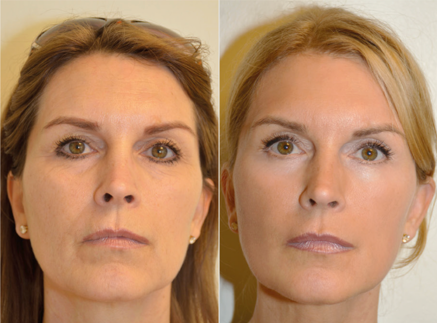 Non-Surgical Facelift in Clearwater: PDO Thread Lifts by Dr. Nadia, 30-Year Facial Expert