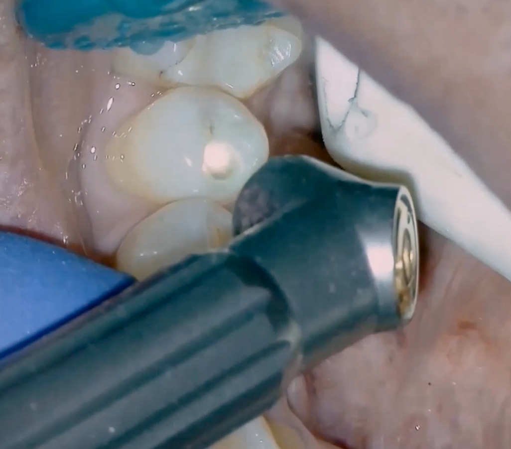 Solea® Laser Treatment