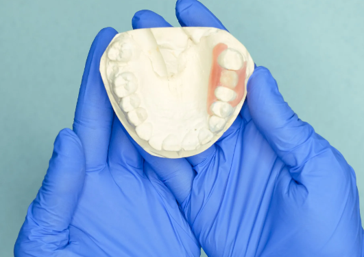 Dental bridges