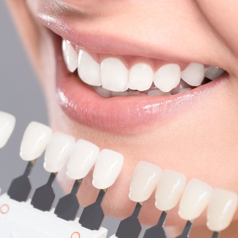 Porcelain Veneers- Greensboro, NC