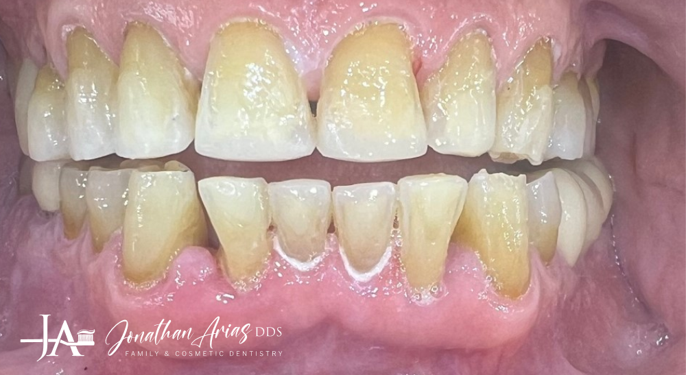 A close up of a person 's teeth with a lot of plaque on them.