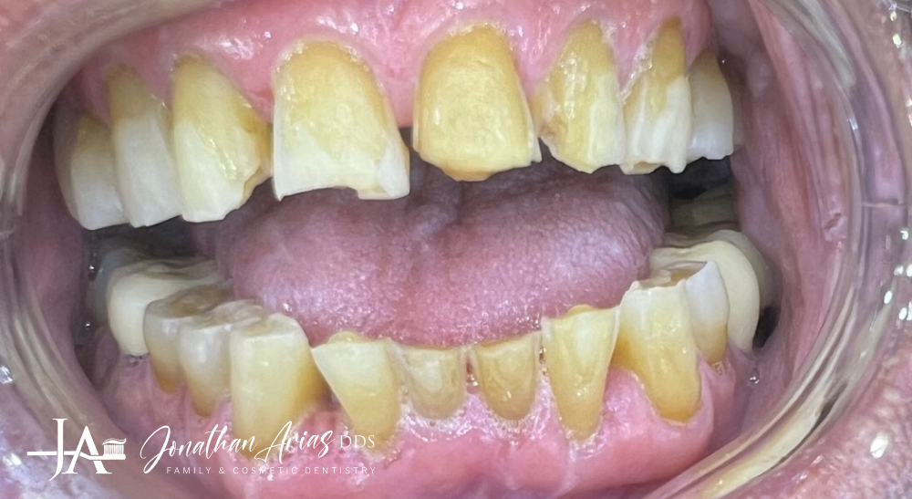 A close up of a person 's mouth with very dirty teeth.