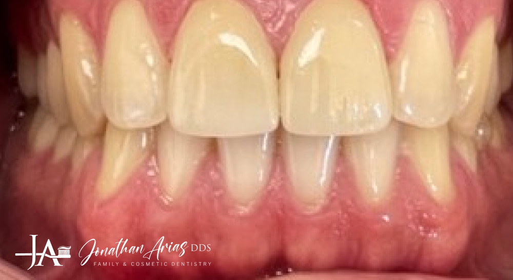 A close up of a person 's teeth with white teeth.