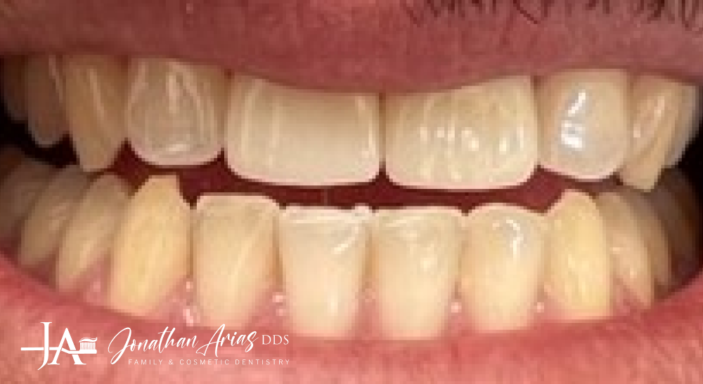 A close up of a person 's teeth with a broken tooth.