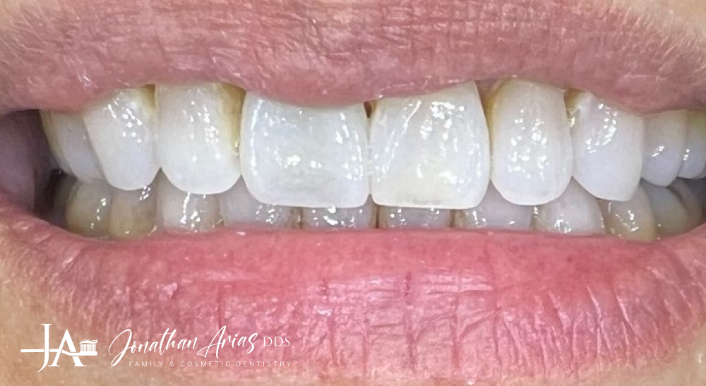 A close up of a person 's teeth with a pink lip.