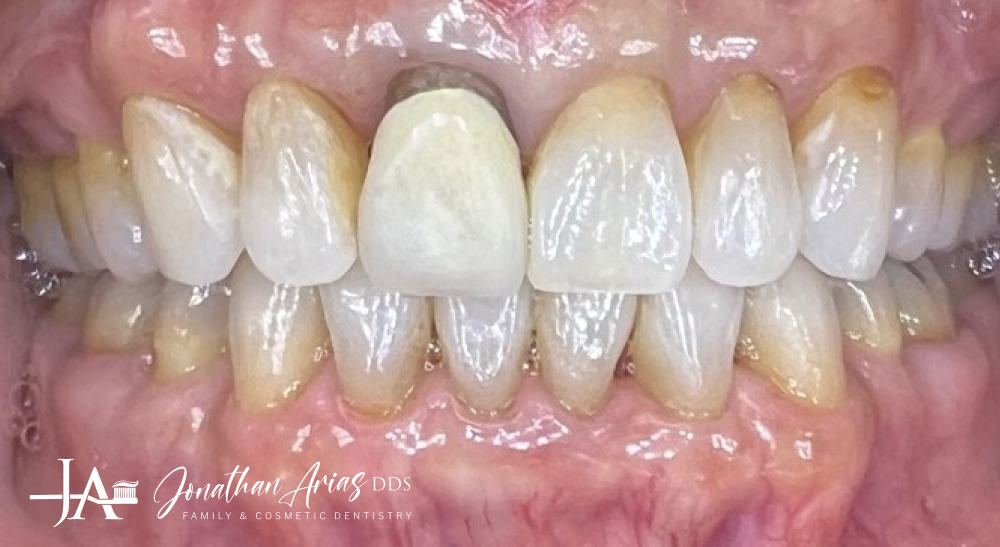 A close up of a person 's teeth with a tooth missing.