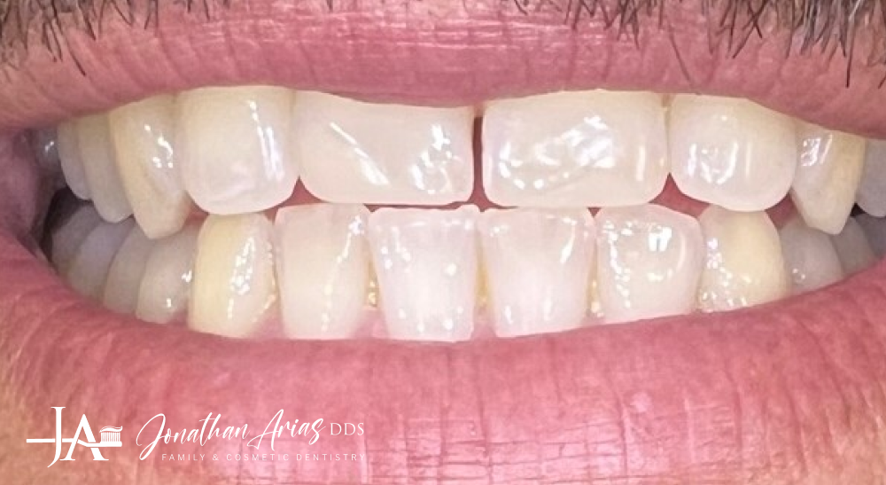 A close up of a person 's teeth with white teeth.