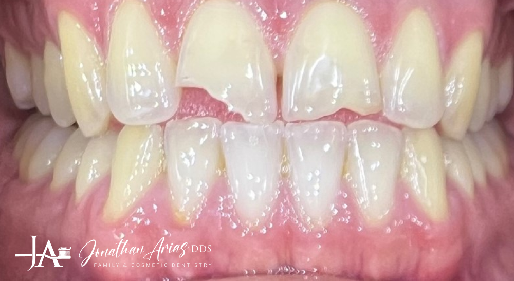 A close up of a person 's teeth with a broken tooth.