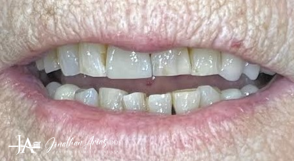 A close up of a person 's mouth with a lot of teeth.