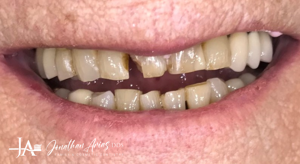 A close up of a person 's teeth with missing teeth.