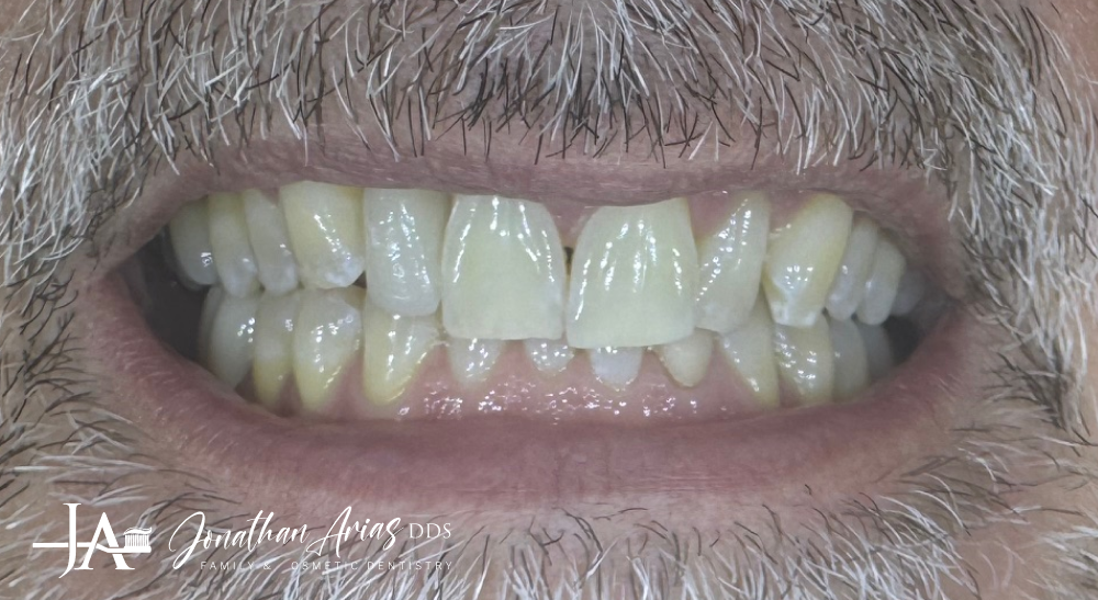 A close up of a man 's teeth with a beard.