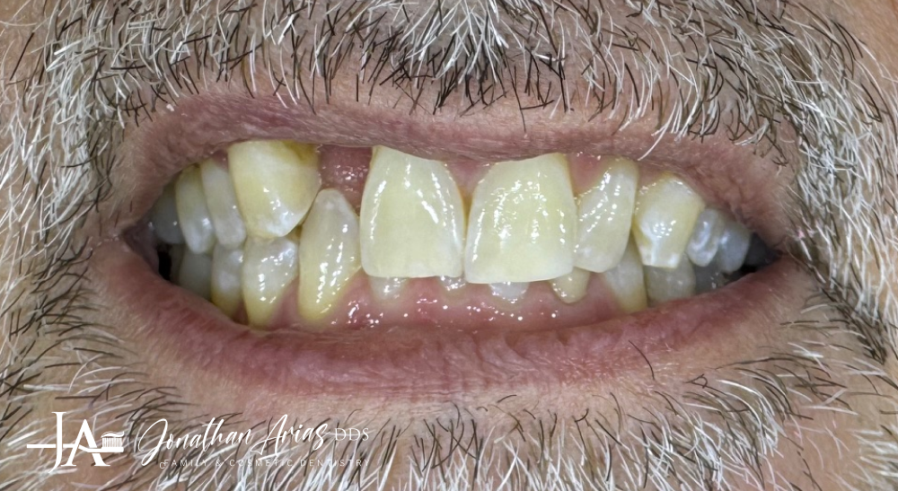 A close up of a man 's teeth with a beard.