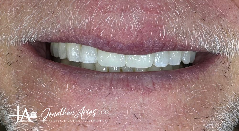 A close up of a man 's mouth with white teeth.