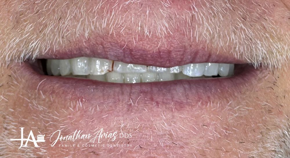 A close up of a man 's mouth with a beard and white teeth.