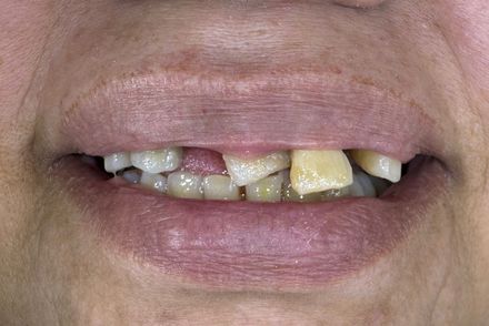 A close up of a person 's mouth with missing teeth.