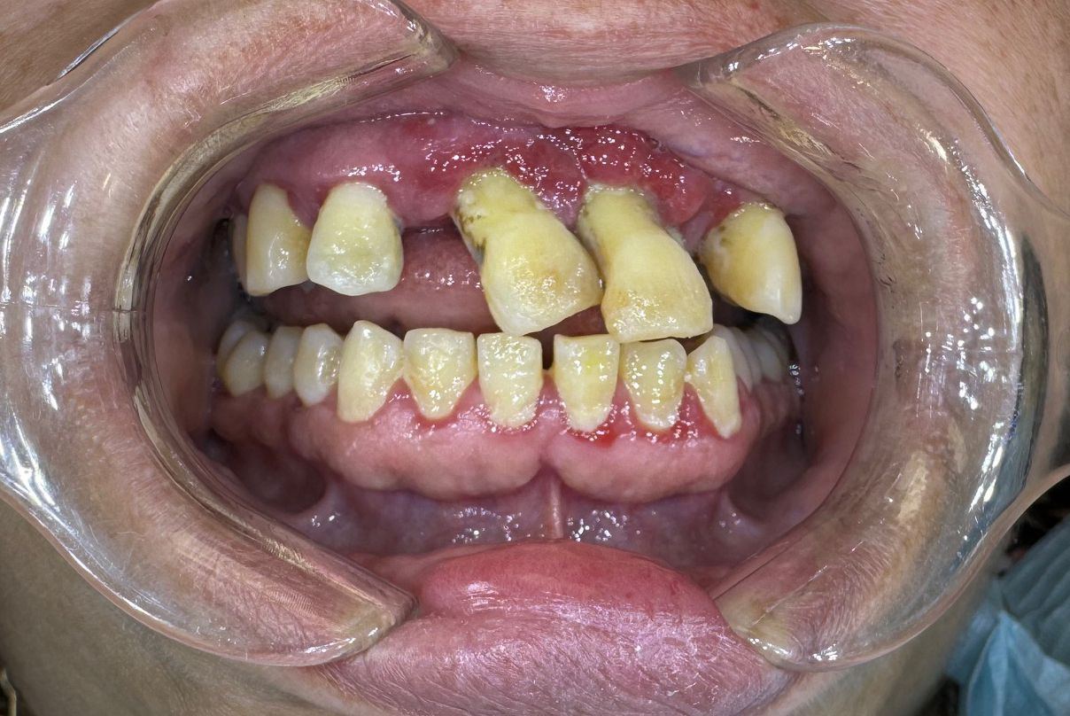 A close up of a person 's mouth with a mouth guard on.