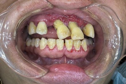 A close up of a person 's mouth with a mouth guard on.