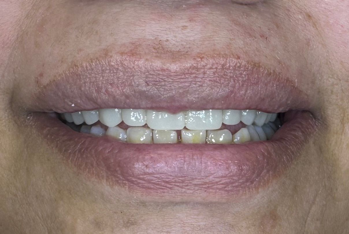 A close up of a woman 's mouth with white teeth.