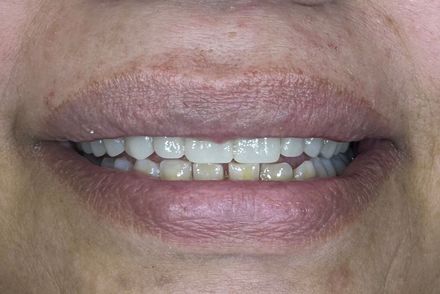 A close up of a woman 's mouth with white teeth.