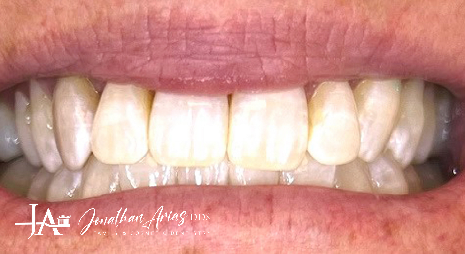 A close up of a person 's teeth with white teeth.
