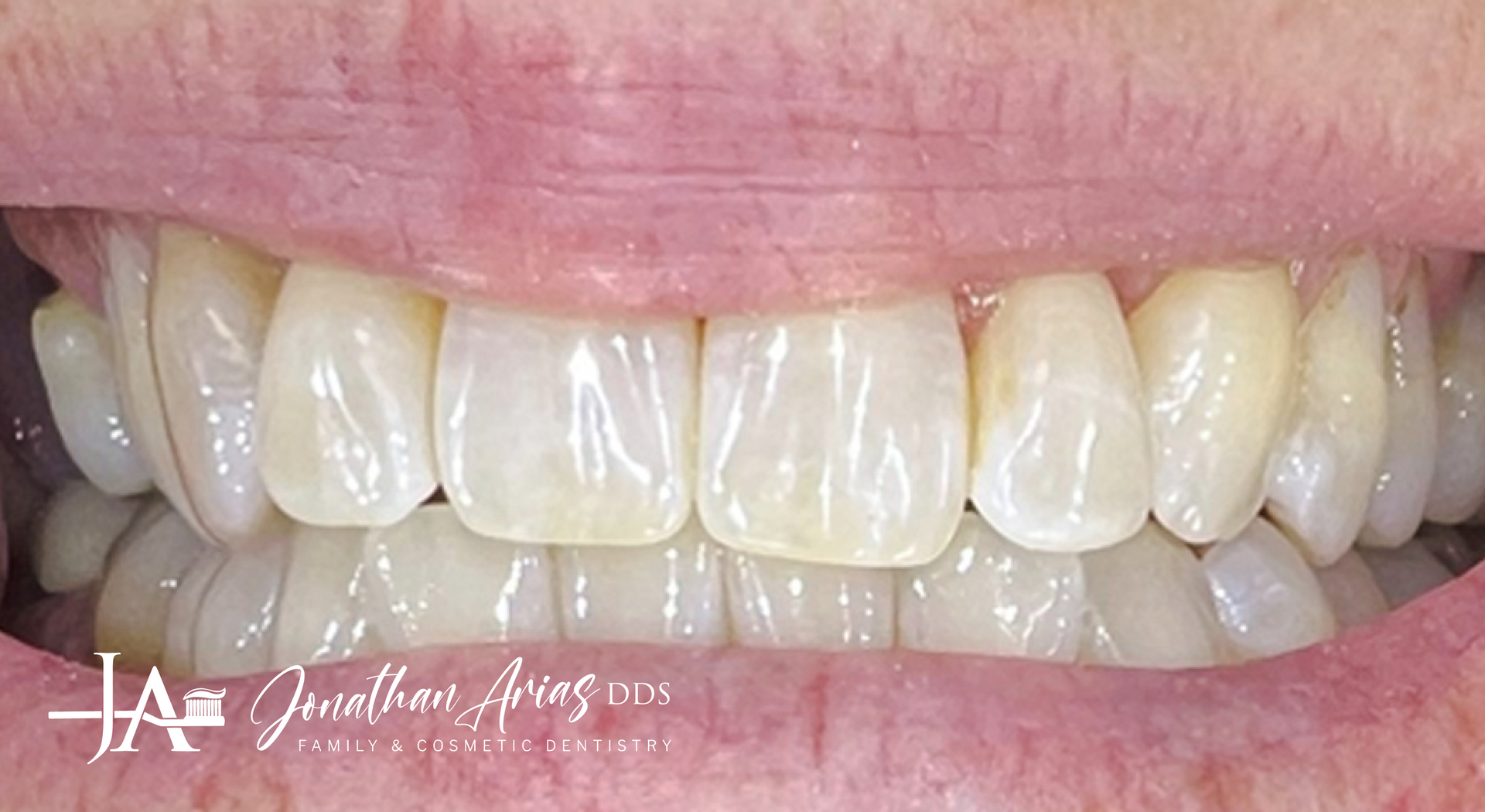 A close up of a person 's teeth with white teeth.