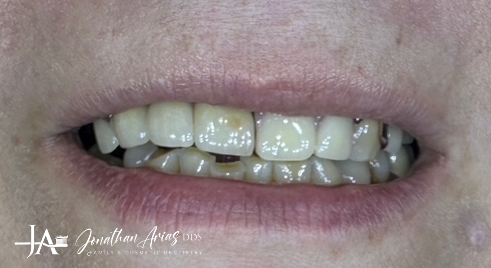 A close up of a person 's mouth with white teeth.