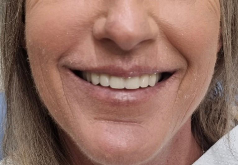 Close-up of a Smiling Mouth and Lower Face With Visible Teeth and Light Lipstick — Smiles On Hobart in Glenorchy, TAS