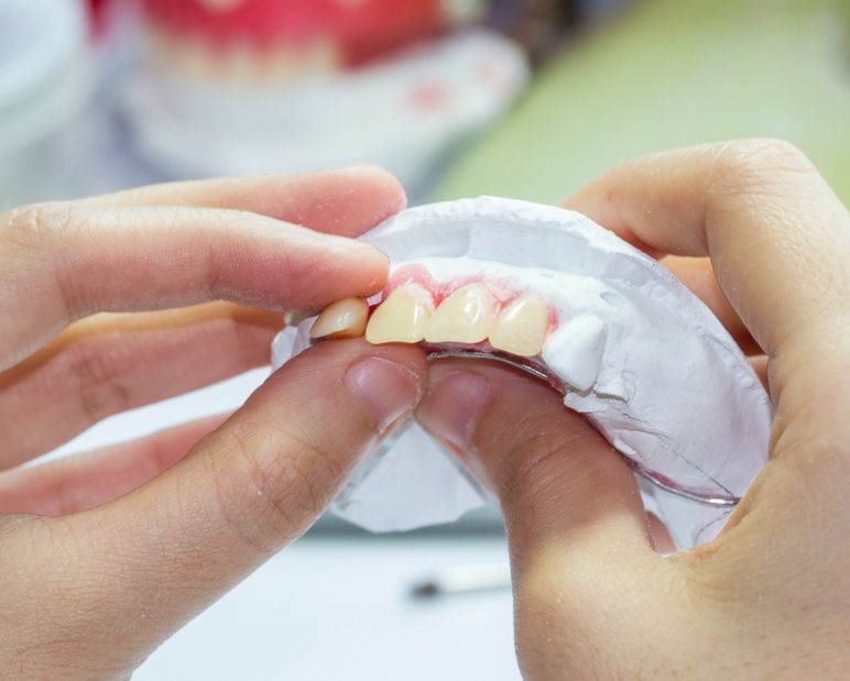 Hands Holding a Dental Mold With White Teeth, Being Adjusted on a Workbench — Smiles On Hobart in Kingston, TAS