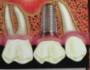 COSMÉTICA DENTAL - CLÍNICA DE IMPLANTES DENTALES COSMÉTICA DENTAL - CLÍNICA DE IMPLANTES DENTALES