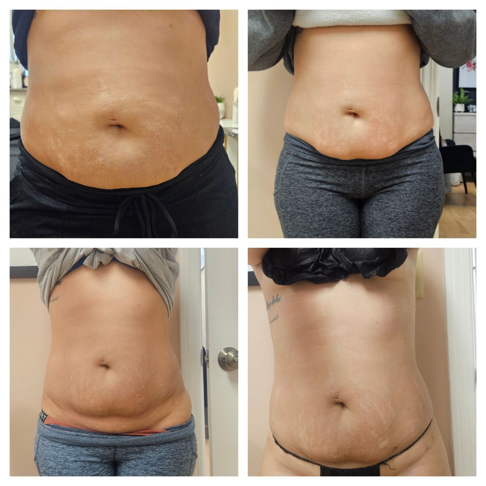 Four pictures of a woman 's stomach before and after surgery