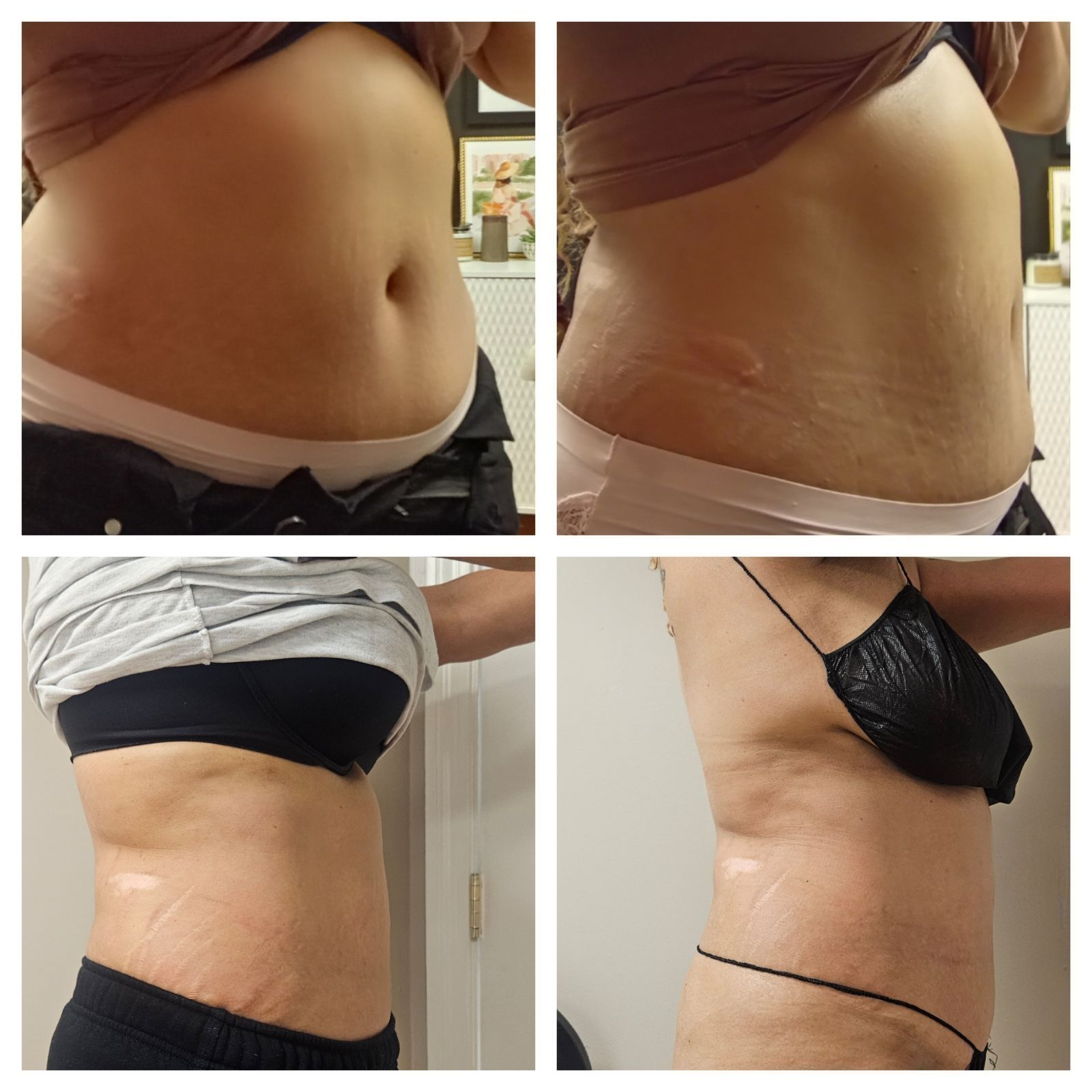 A collage of four pictures of a woman 's stomach