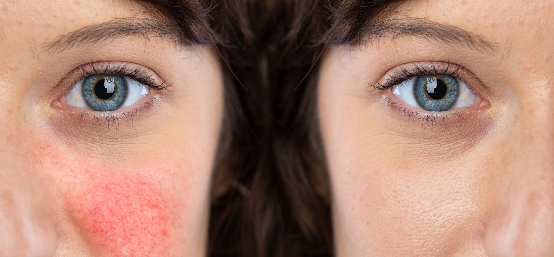 Side-by-side close-ups of a face with red, irritated skin on the left and clearer skin on the right
