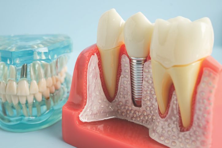 Dental implant model showing a screw in the jawbone with a crown attached, next to a complete set of teeth.