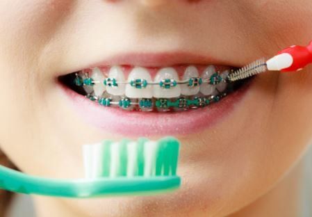 Is Invisalign the Best Option?