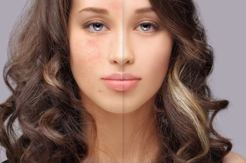 Un confronto affiancato tra un viso con texture cutanea irregolare e rossore a sinistra e una pelle liscia e uniforme a destra.