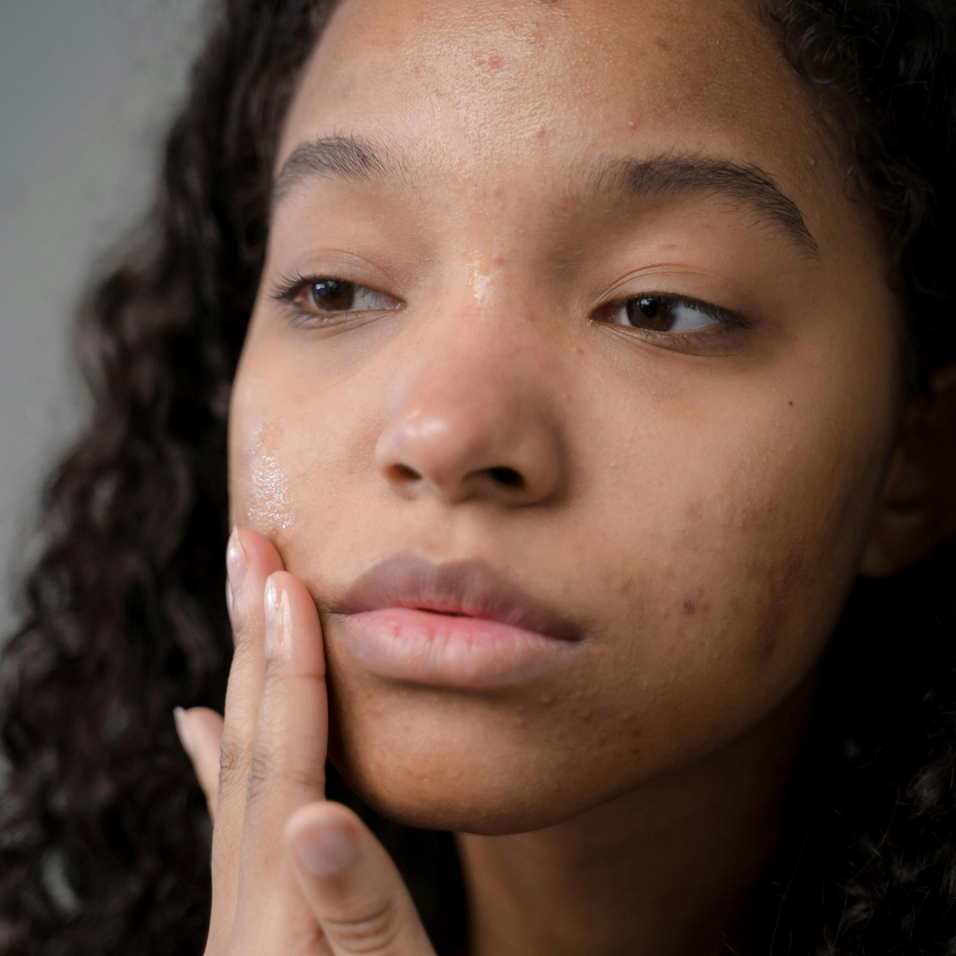 teen acne skincare solutions essential oils natural remedies