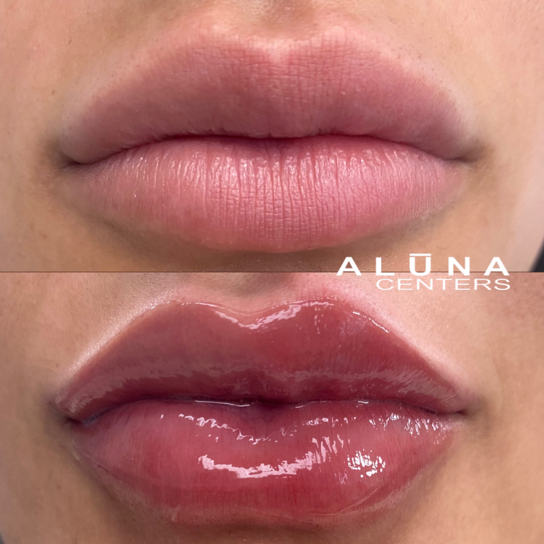 Lip Filler