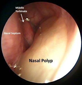 A close up of a nasal polyp with a middle turbinate
