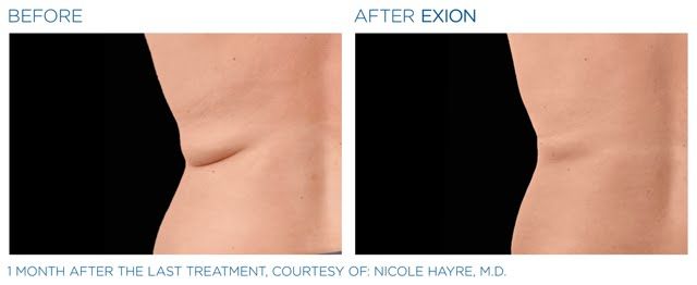 A before and after picture of a woman 's stomach.